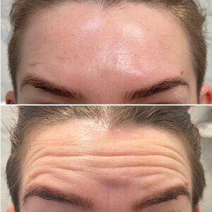 Results botox Resultaat botox